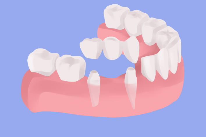 dental bridge surrey delta