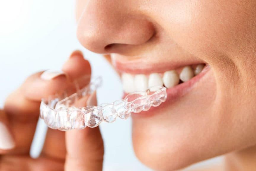 Benefits of Invisible Teeth Aligners Surrey BC - Teeth Alignment